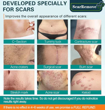 ScarRemove™ Advanced Scar Spray For Acne Scars. Surgical Scars and Stretch Marks