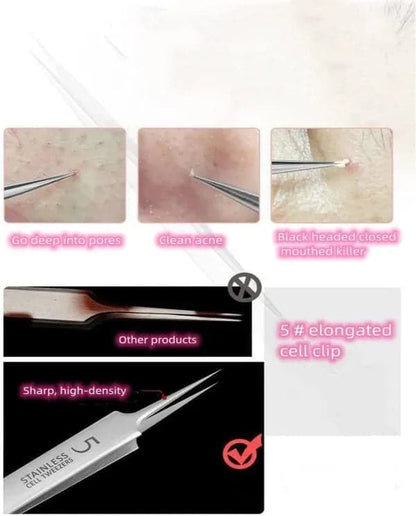 Acne Blackhead Removal Tool Kit