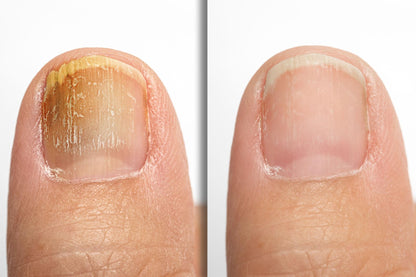 ANTI-FUNGAL NAIL REPAIR POLISH